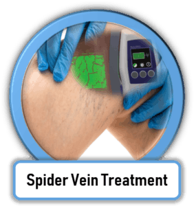 Spider Vein Treatment