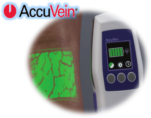 Accuvein laser vein treatment