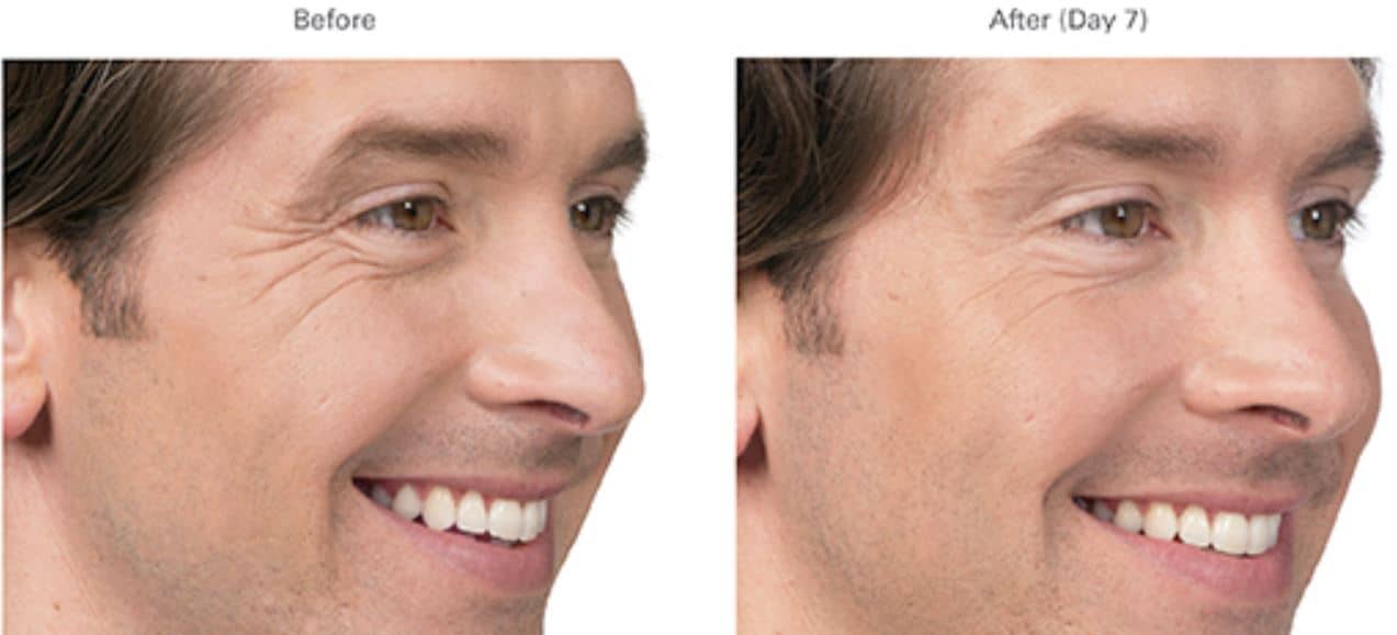 Botox before after 1