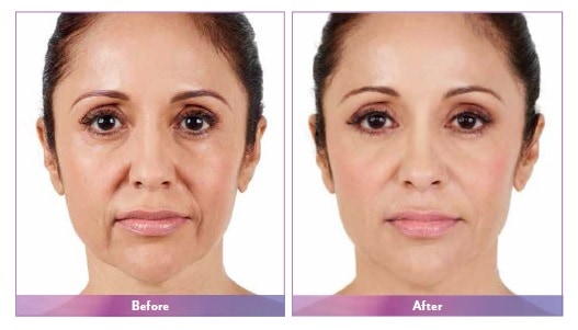 Juvederm before after 2