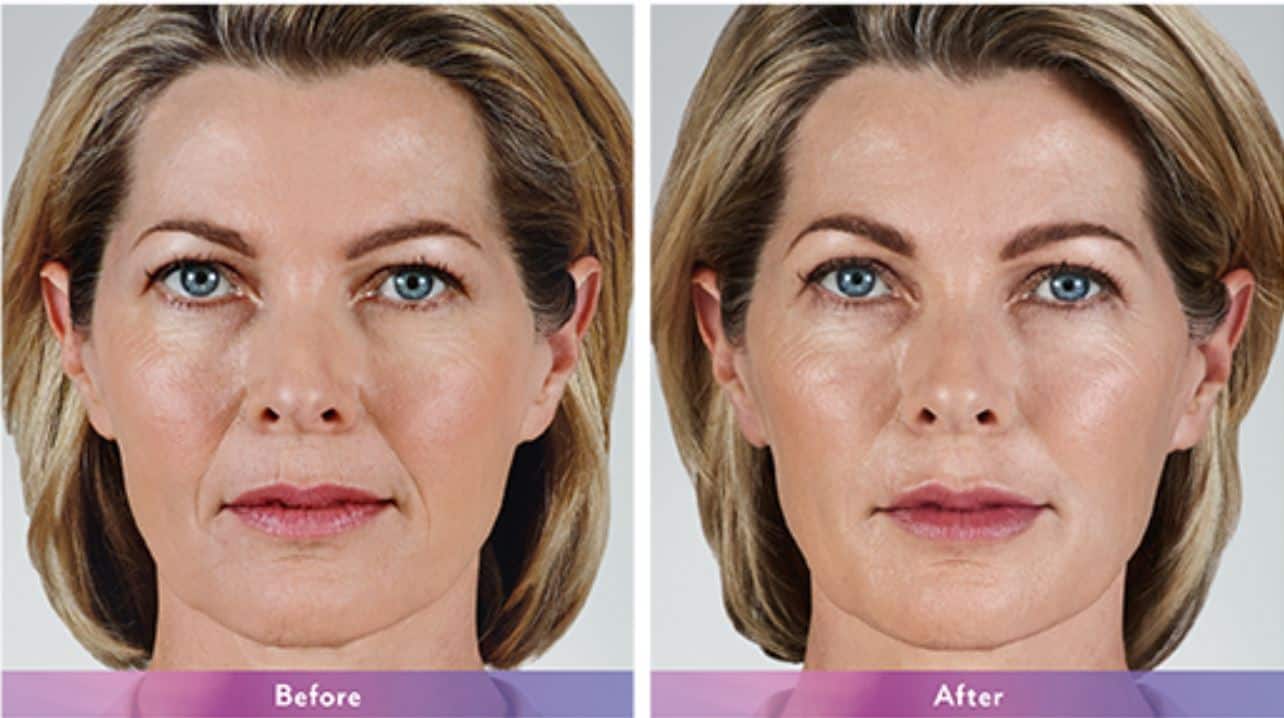 Juvederm before after IMD1