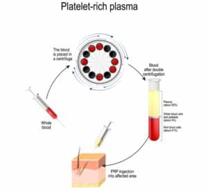 PRP diagram PRP Preparation