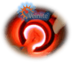 Veinlite with logo Veinlite varicose vein treatment