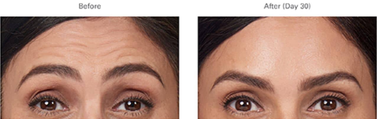 botox before after 2