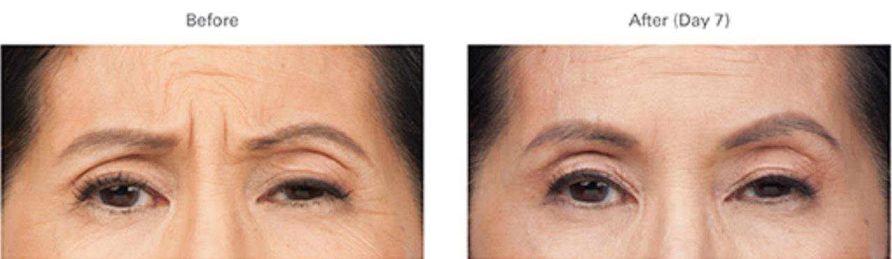 botox before after 3