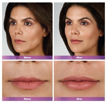 juvederm before after 3