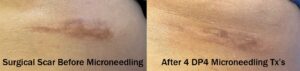 Microneedling surgical scar after 4 treatments