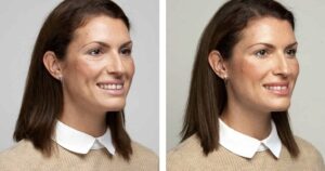 Skinvive face results
