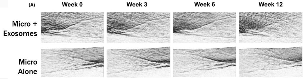 Exosomes results wrinkles with microneedling